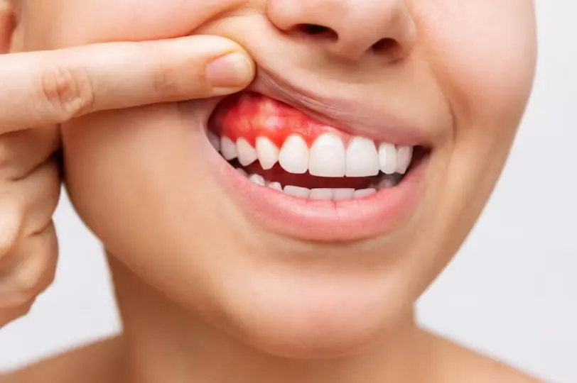 Los lácteos aumentan el riesgo de infecciones en la boca - Qué no puedo comer si tengo infección en la boca los lacteos aumentan el riesgo de infecciones en la boca - Qué no puedo comer si tengo infección en la boca